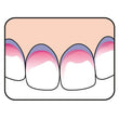 Load image into Gallery viewer, TePe Plaqsearch Disclosing Tablets illustration showing new and old plaque differentiation on teeth.