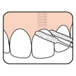 Load image into Gallery viewer, TePe Bridge and Implant Floss demonstration for cleaning implants and braces.