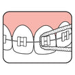 Load image into Gallery viewer, TePe Bridge and Implant Floss illustration showing use with braces.